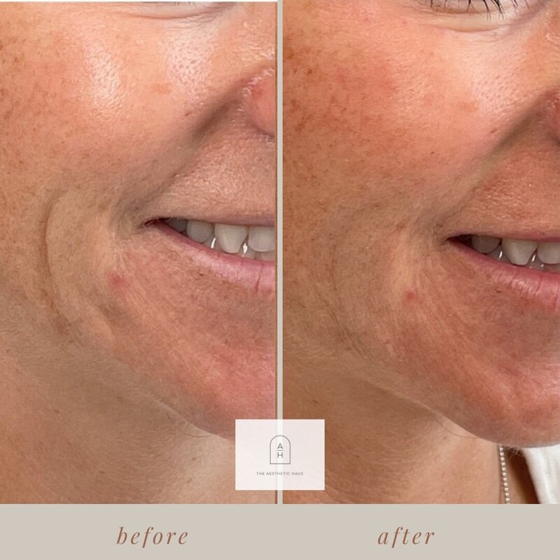 Juvederm Skinvive - Smile Lines 2
