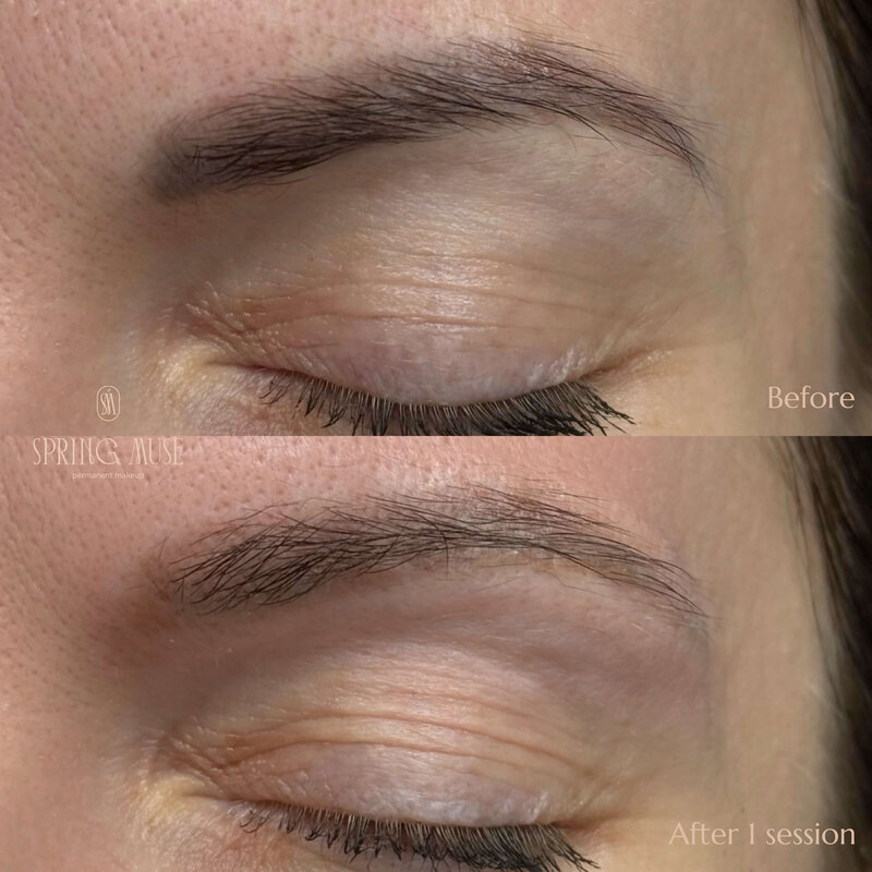 Laser microblading removal NYC