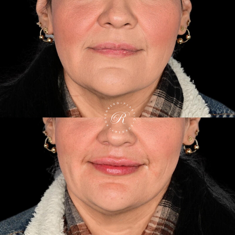 Non-surgical Lip Augmentation RPS Before & Afters.zip - 3
