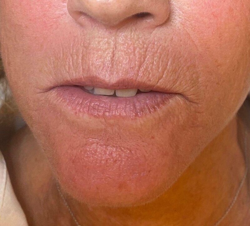 carbonpeel soins esthétique