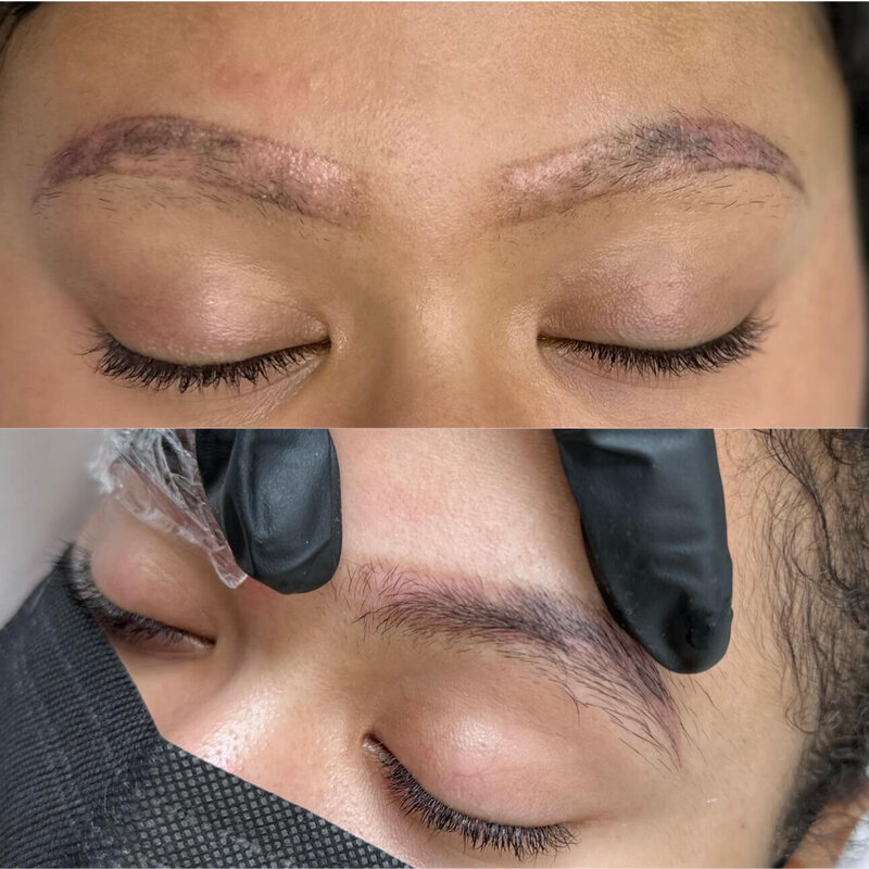 saline eyebrows removal new york