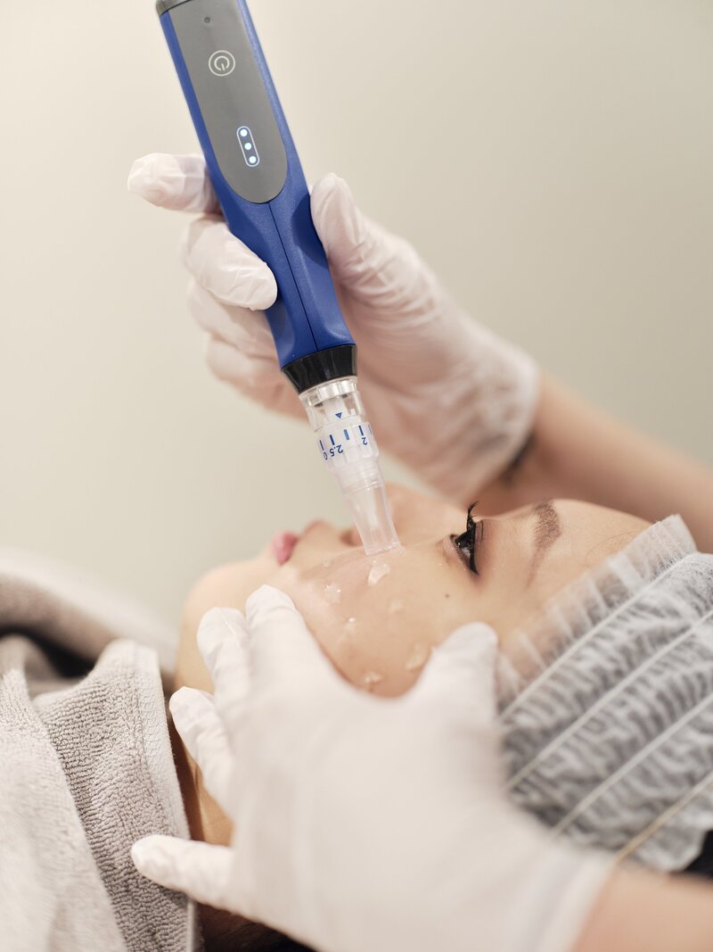 Client receiving a SkinPen microneedling treatment, a minimally invasive procedure that stimulates collagen production for smoother, firmer, and more radiant skin.