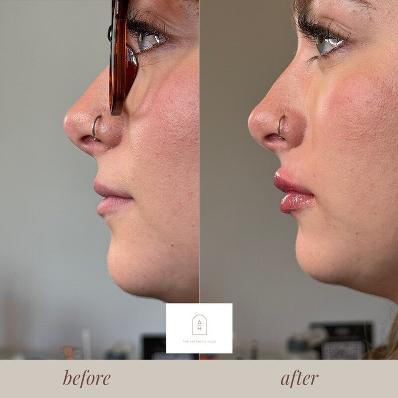 Lip Filler NC
