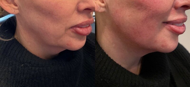 Sculptra before photo 