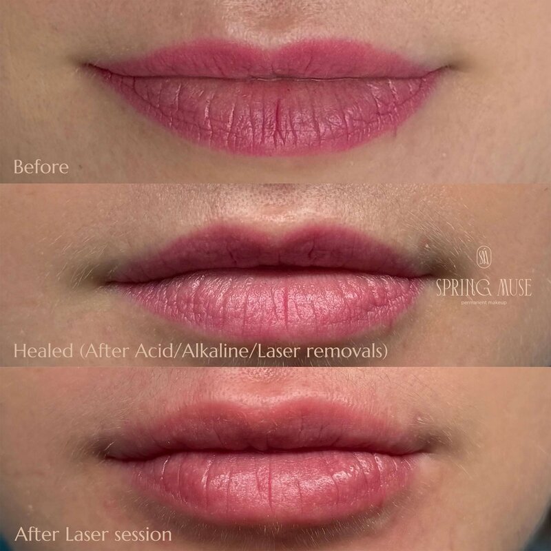 Lip Blush laser and acid remover removal NYC