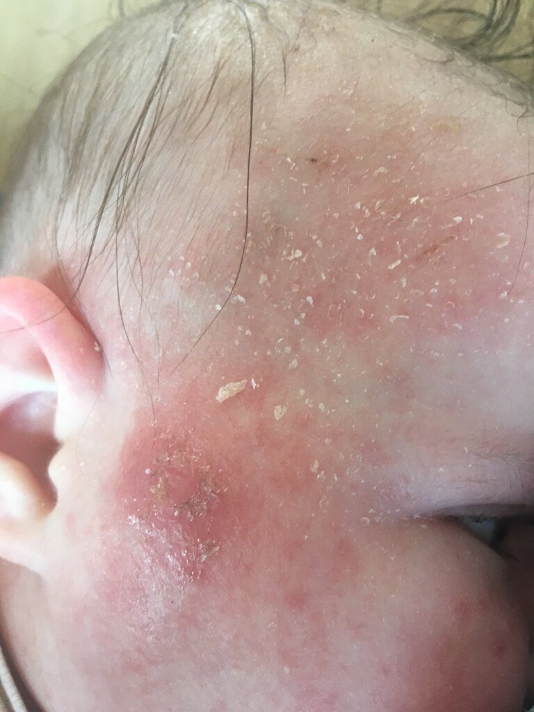 natural eczema treatment