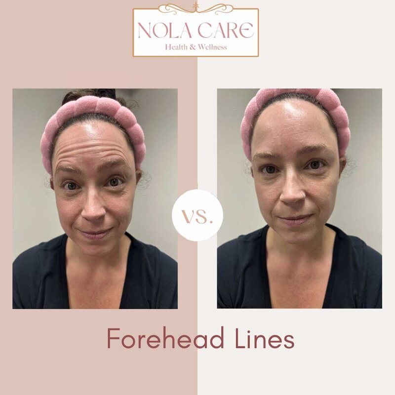 Botox Before and Afters forehead wrinkles