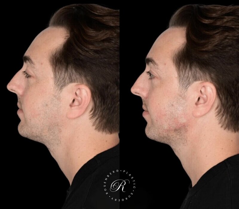 Non-surgical ChinJaw Augmentation RPS Before & After.zip - 29