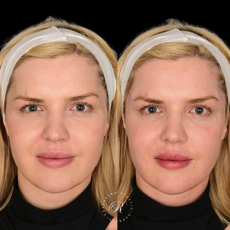 Dermal Fillers to the Temple