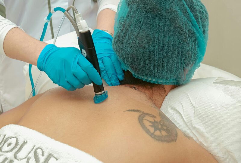 client mid treatment for tattoo removal at luscious skin & beauty Warrnambool