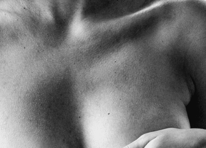 Neck bands form when the platysmal muscles of the neck are hyperactive. This presents as vertical tissue protrusions that run the length of the neck and worsen on muscle contraction. Relaxing these muscles with botulinum toxin injections tighten the neck and jawline, as well as improve horizontal neck lines.