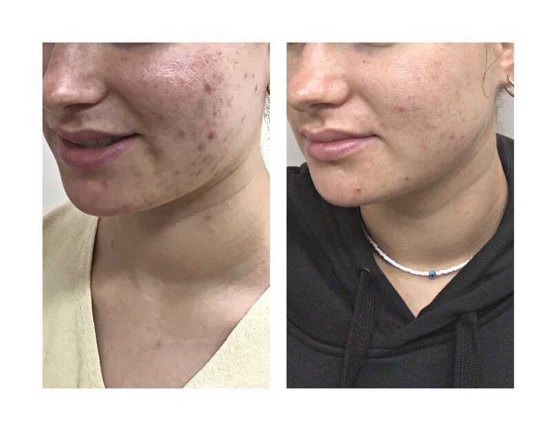 Hx: Patient presented for improvement of her ‘gummy smile’ and nasolabial folds (lines that run from nose corners to corners of mouth) which she felt had worsened since losing a significant amount of weight.