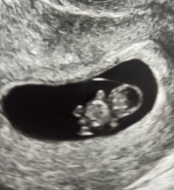 2D 8week ultrasound image