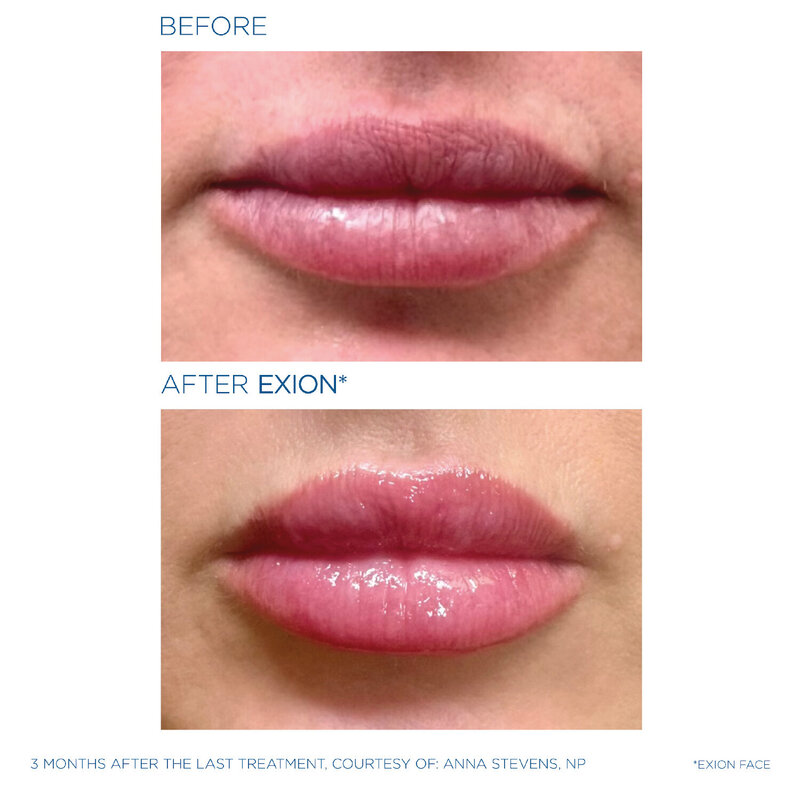 Exion before and after photo of lips