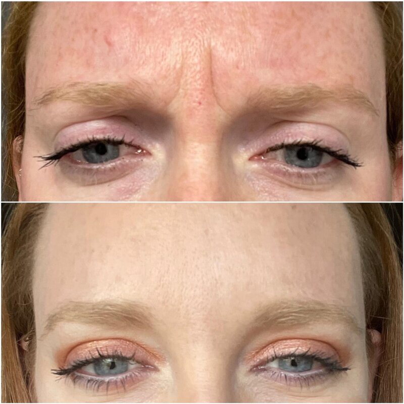 Botox before and after on the forehead
