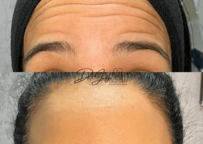 Botox-lines-on-forehead-before-and-after-2-400x284