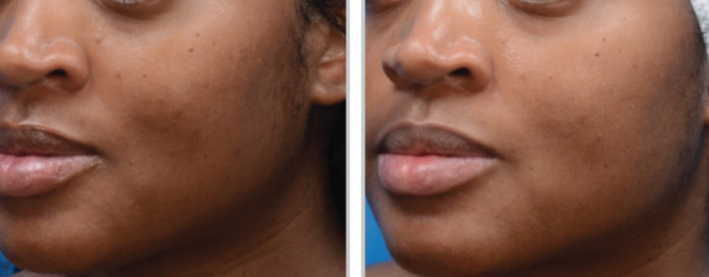 Transformation from MOXI laser facial: evened skin tone, reduced pigmentation, and improved glow