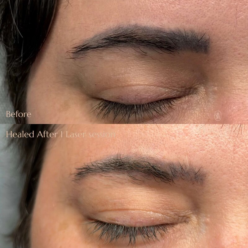 Laser Eyebrows Removal New York