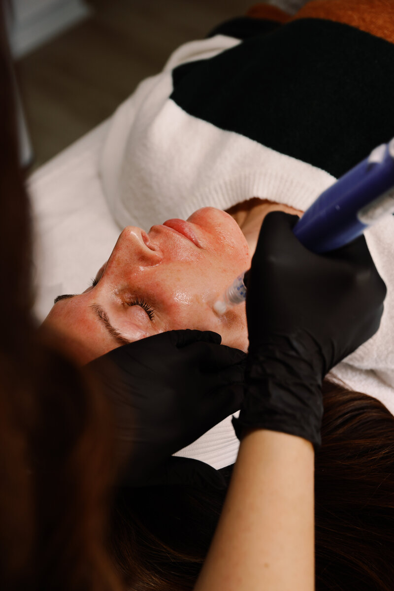 Facial injectables treatment using Botox and fillers at a Burlington aesthetics clinic.