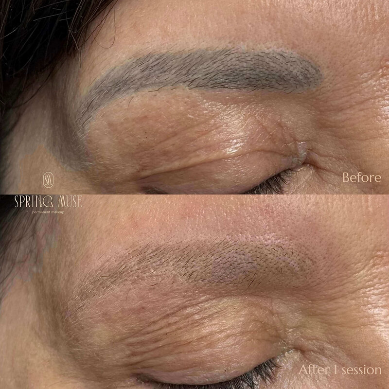 Laser microblading removal NYC