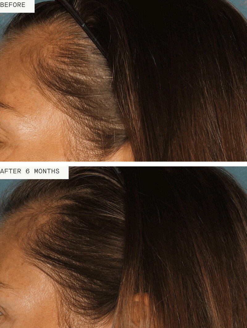 BeautyInScieneMedspa_beforeafter hair restoration growth