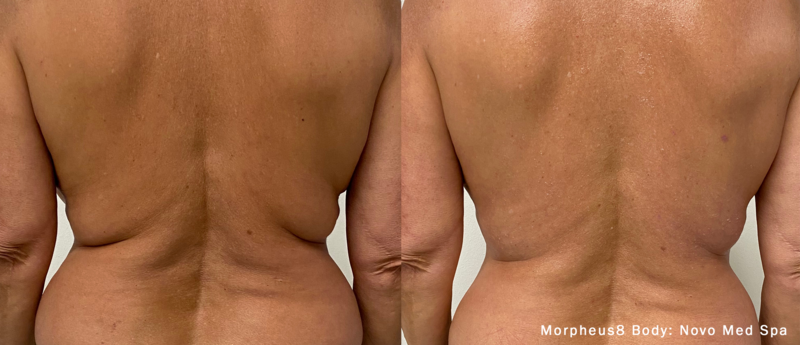 Morpheus8 Body Before & After