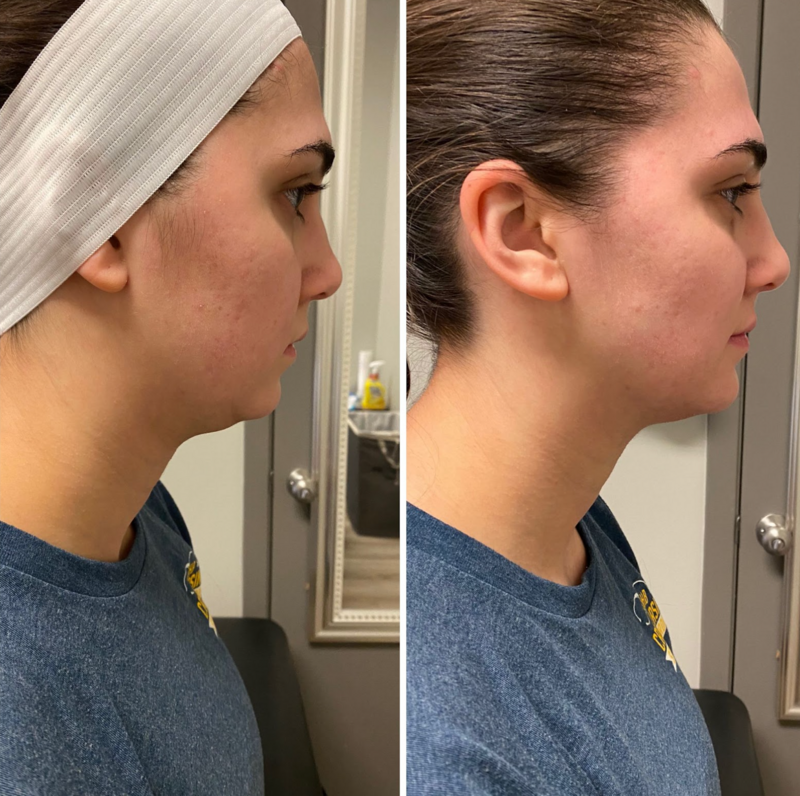 Before and after cryoskin treatment