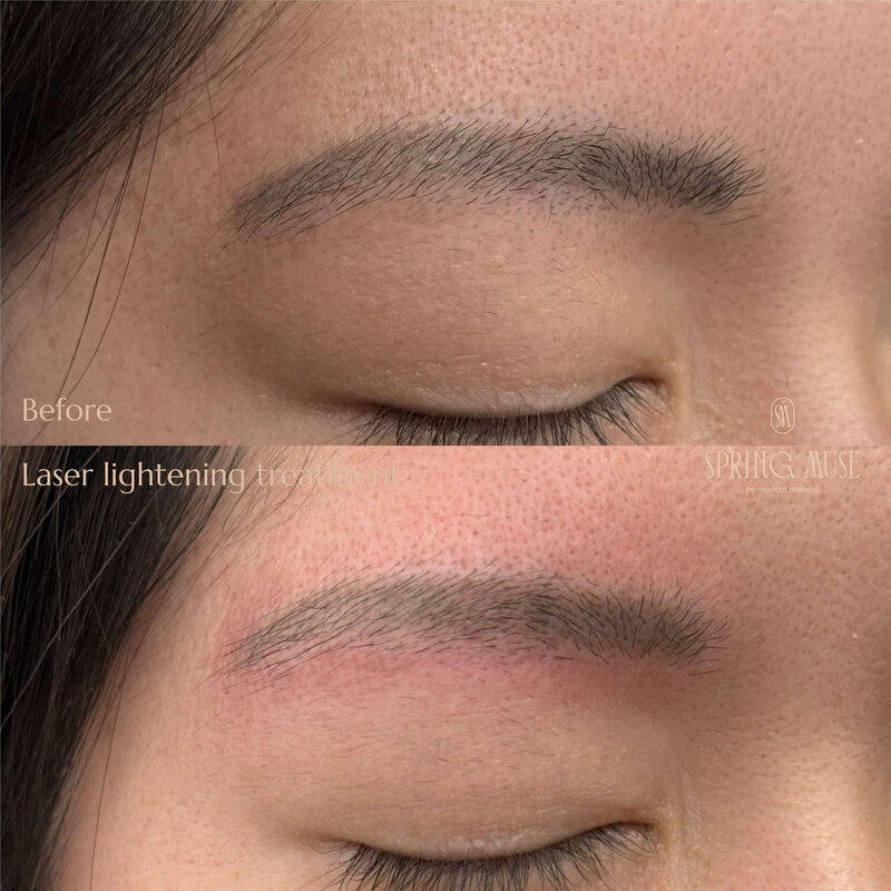 Laser Eyebrows Removal New York