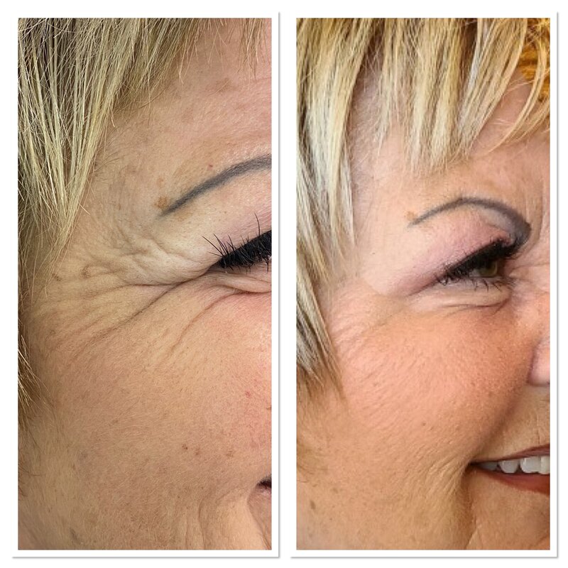 Beauty and Grace Aesthetics Botox patient before and after