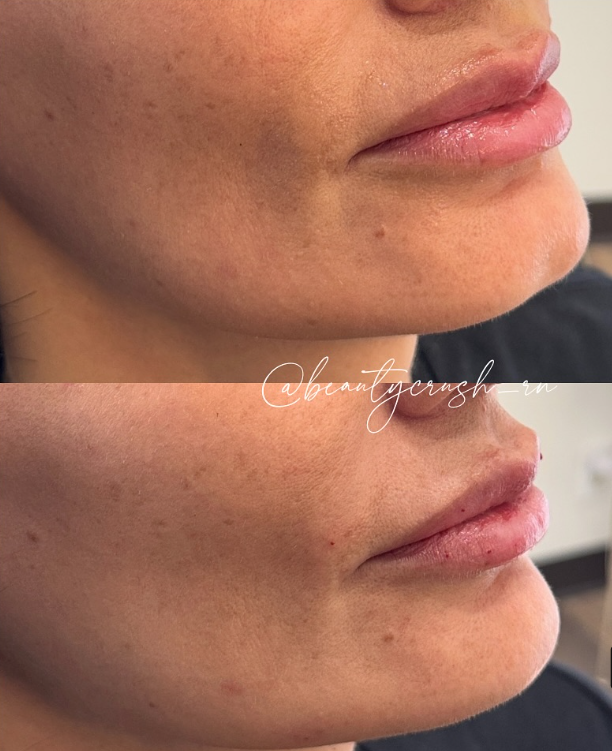 Cleft Chin