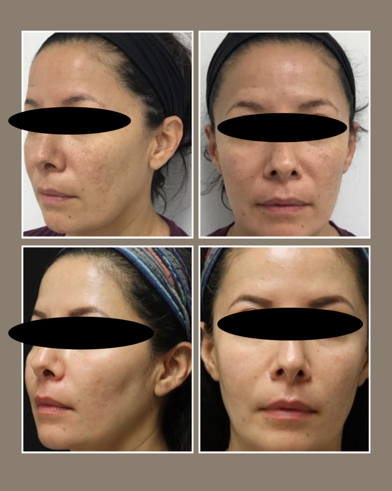 Injectables - Glösense Dermatology and Aesthetics, Miami