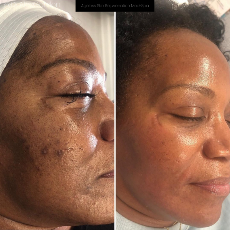 Neo Elite® - NeoSkin® - Skin Rejuvenation (SOC)