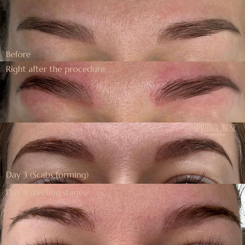 Acid Microblading Removal NYC