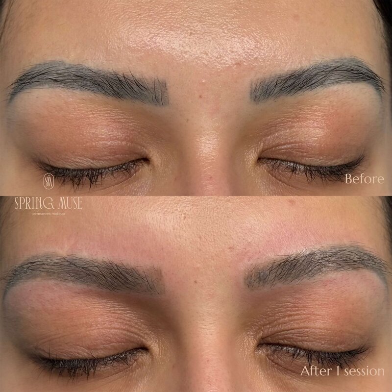 Laser Eyebrows Removal New York