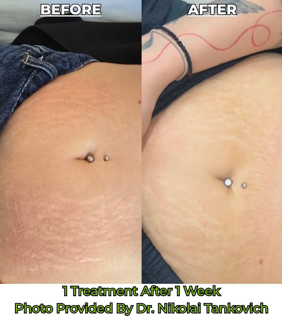 Striae Stretchmarks