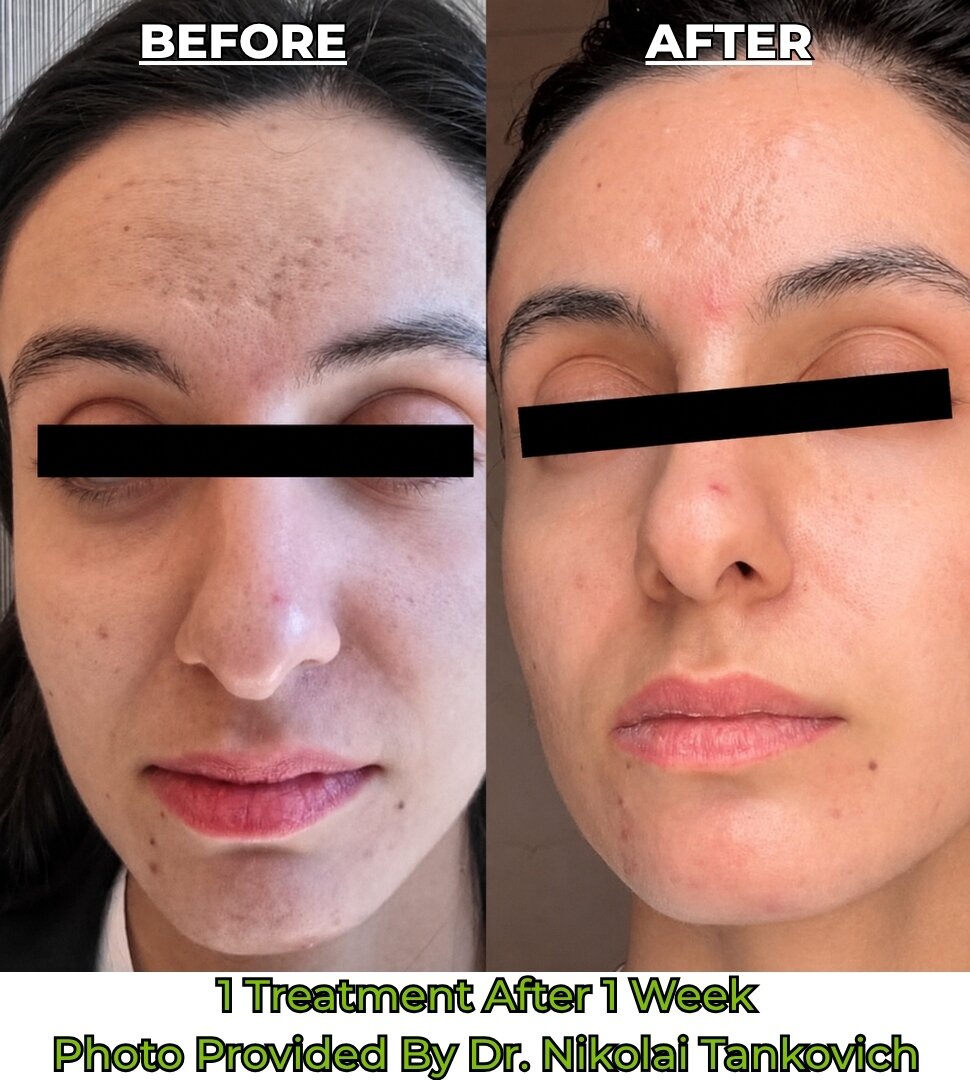 Before and After