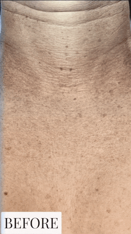 before and after skin care treatment