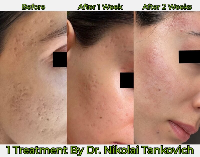 Before and After