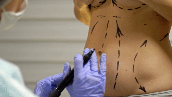 Gif of woman getting incision drawing on abdomen