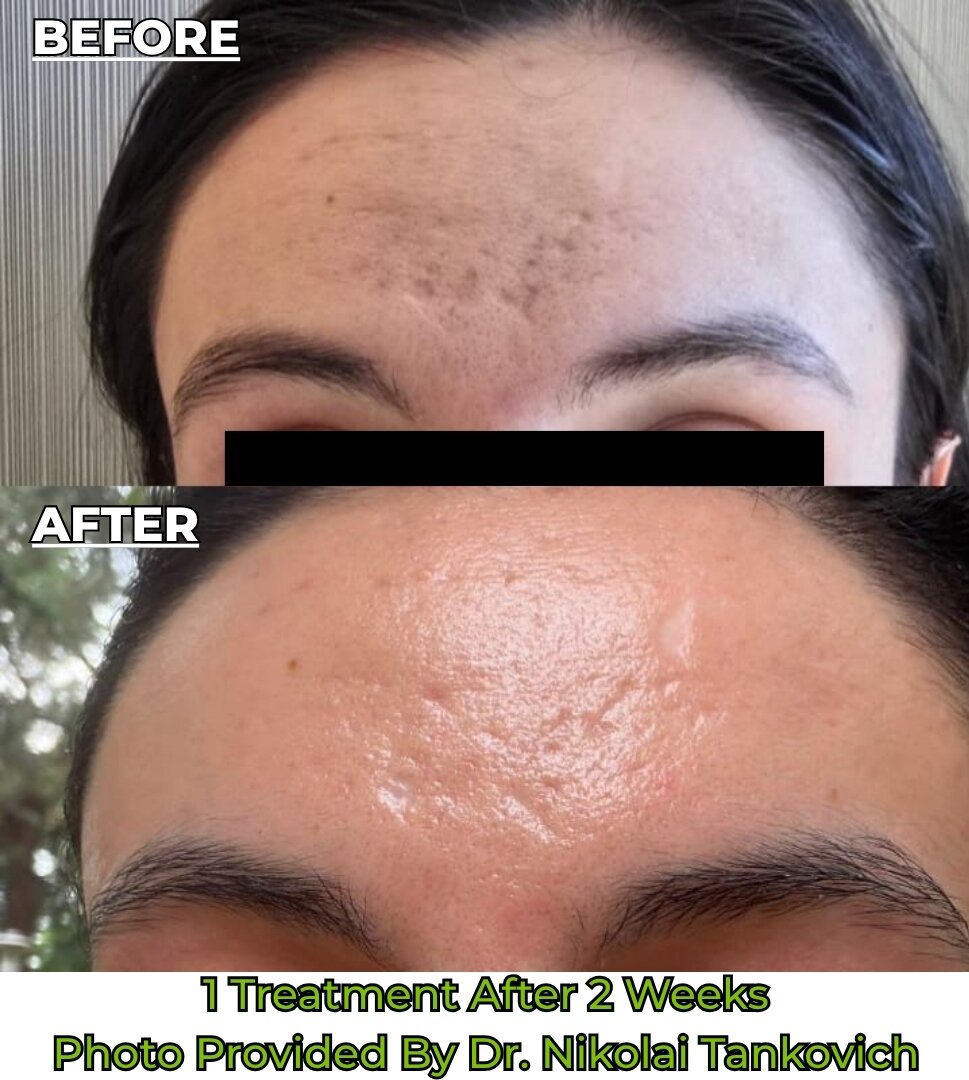 Before and After