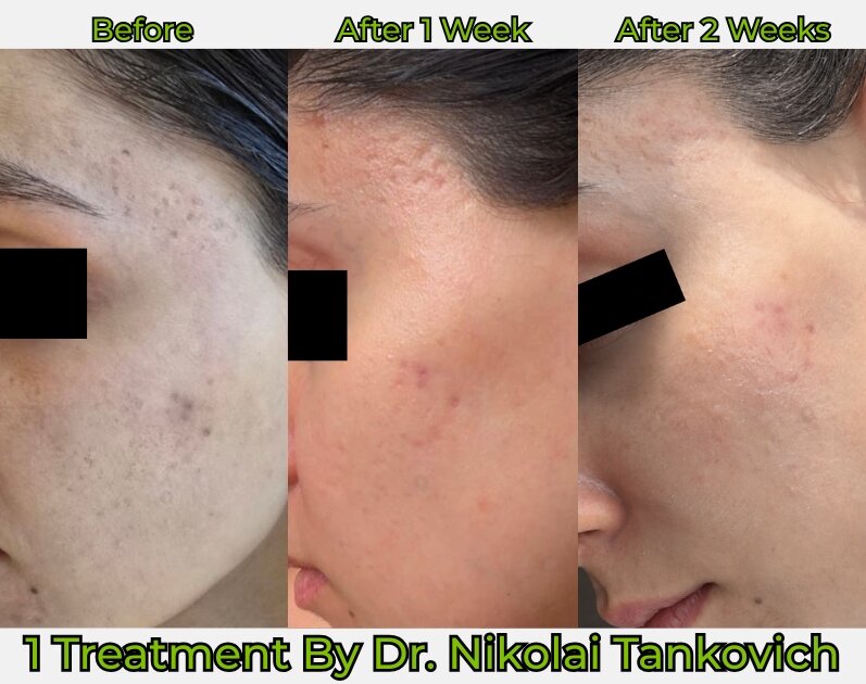 Before and After